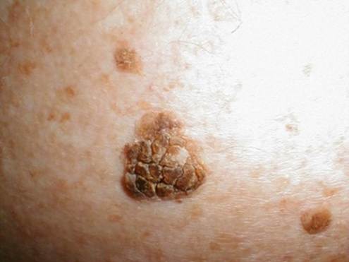 DRNP 6540 Week 3 Knowledge Check: Skin and Lymphatic Disorders